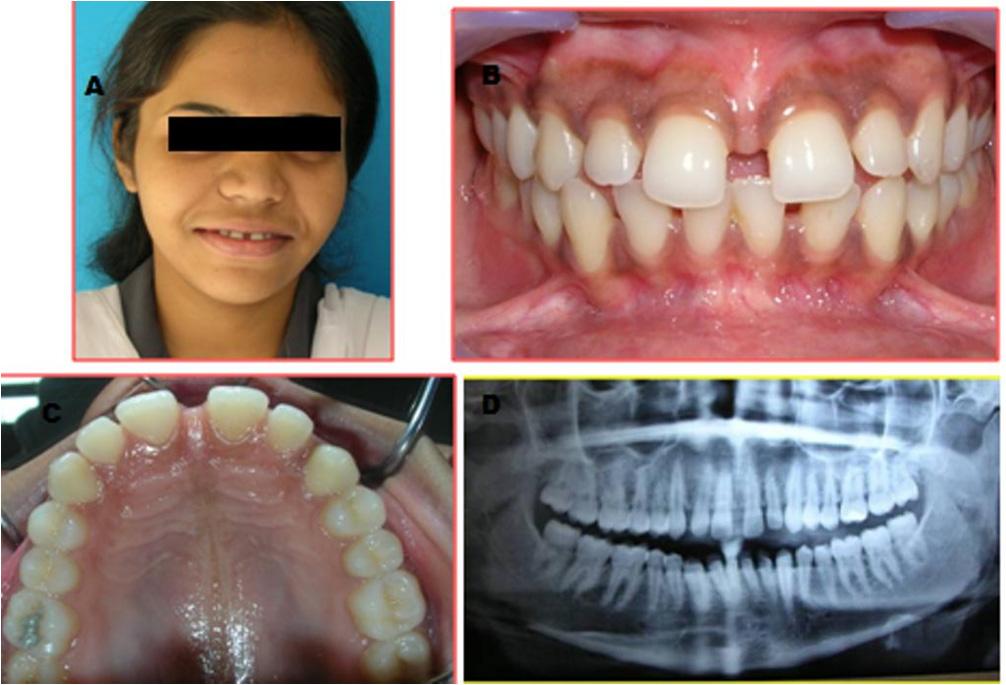 Figure 3: Preoperative view of patient showing spaces with anterior teeth. (A) Preoperative view of the patient during smile.