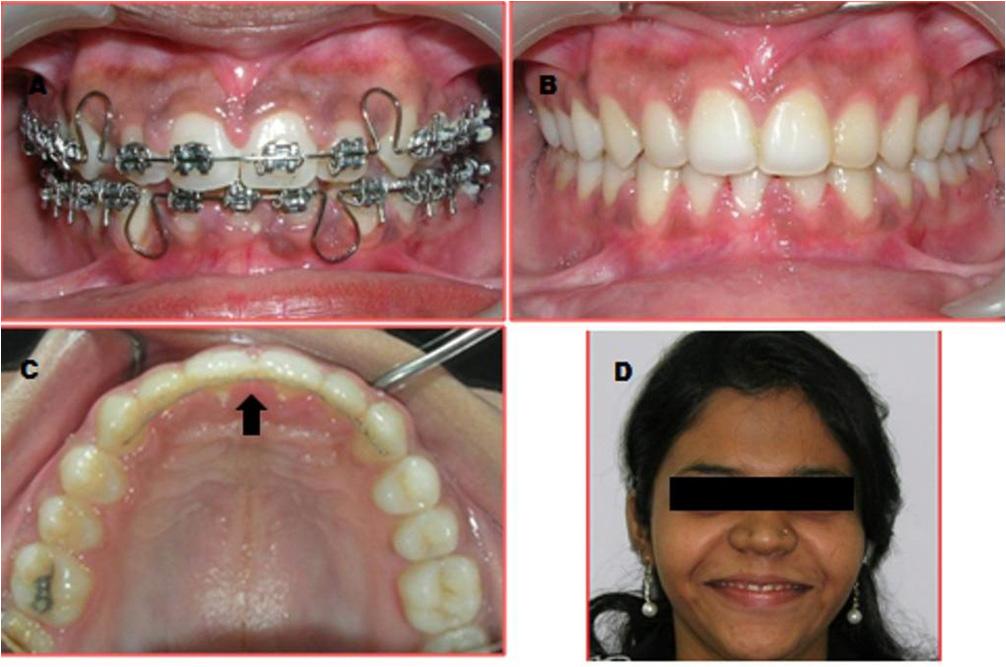(D) Orthophantamograph (OPG) Figure 4: Post operative photographs of patient treated with fixed orthodontic mechanotherapy for
