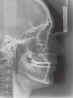 Orthodontic Management of Crowded Class III case 45 Figure 6.