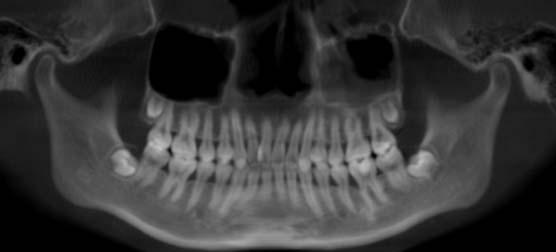Inclusive criteria Patients aged 18-25 years had complete dentition in the study area (excluding third molars) confirmed via clinical and X-ray examination, and presented no significant bone