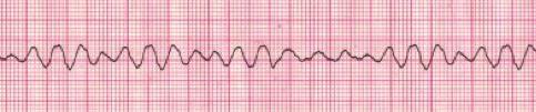 VENTRICULAR FIBRILLATION AND PULSELESS VENTRICULAR TACHYCARDIA Ventricular fibrillation (VF) and pulseless ventricular tachycardia (VT) are life-threatening cardiac rhythms that result in ineffective