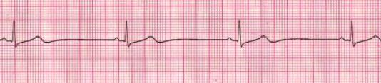 RULES FOR SINUS BRADYCARDIA RULES FOR FIRST DEGREE Figure 31 Figure 32 REGULARITY R-R intervals are regular, overall rhythm is regular. REGULARITY R-R intervals are regular, overall rhythm is regular. RATE The rate is less than 60 bpm, but usually more than 40 bpm.