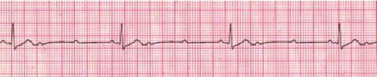 The atrial rate is usually normal. REGULARITY RATE If there is a consistent conduction ratio, then the R-R interval will be regular.