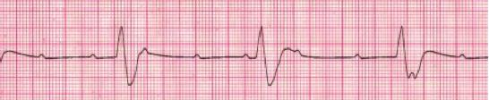 ACLS CASES RULES FOR 3RD DEGREE AV BLOCK (COMPLETE HEART BLOCK) Figure 35 Table 14 REGULARITY RATE P WAVE PR INTERVAL QRS COMPLEX R-R interval is regular. P-P interval is also regular.
