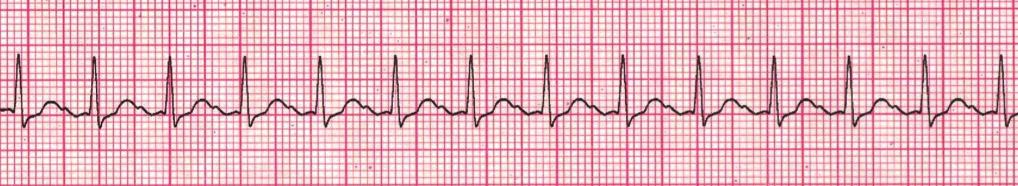 ACLS CASES IRREGULAR NARROW COMPLEX TACHYCARDIA (PROBABLE A-FIB) Obtain 12-lead ECG; consider expert consultation. Control rate with diltiazem 15 to 20 mg (0.