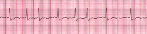 RULES FOR ATRIAL FLUTTER RULES FOR ATRIAL FIBRILLATION (A-FIB) IRREGULAR NARROW COMPLEX TACHYCARDIA = A-FIB Figure 38 Figure 39 REGULARITY RATE P WAVE PR INTERVAL QRS COMPLEX The atrial rate is