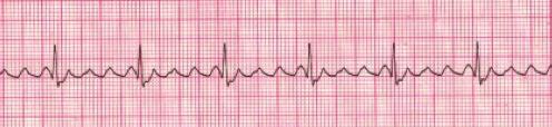 The atrial rate is normally between 250 to 350. Ventricular rate depends on conduction through the AV node to the ventricles. The P waves will be well defined and have a sawtooth pattern to them.