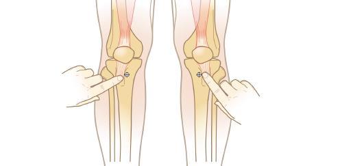 IO Insertion Site Instructions Proximal Tibia Adults Extend the leg - insertion site is approx.