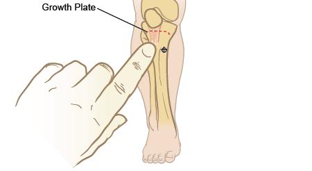 Proximal Tibia Infants & Small Children Extend the leg - insertion site is just below the patella, approx.