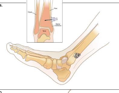 Pinch the tibia between your fingers to identify the center of the medial and lateral borders. Distal Tibia Adults Approx.