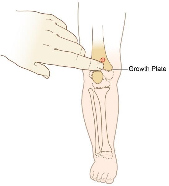 Distal Femur Infants & Small Children Secure the leg out-stretched to ensure the knee does not bend. Identify the patella by palpation.