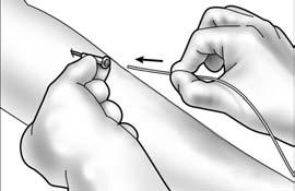 Apply slight pressure on the vessel above the insertion site to minimize blood flow.