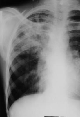 RUL Excavated pneumonia Pneumonia + adenopathies RLL