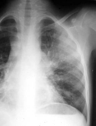 adenopathies are often associated and TB pneumonia is often