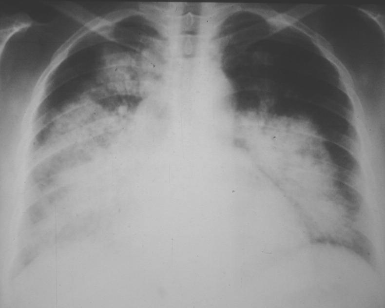 Typical pulmonary