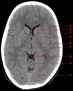 www.dramir.net A. Anterior Horn of the Lateral Ventricle B. Caudate Nucleus C. Anterior Limb of the Internal Capsule D.