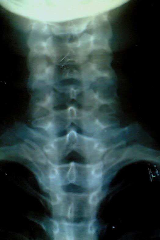 Lateral view shows : Cx Spine Curve of the spine.