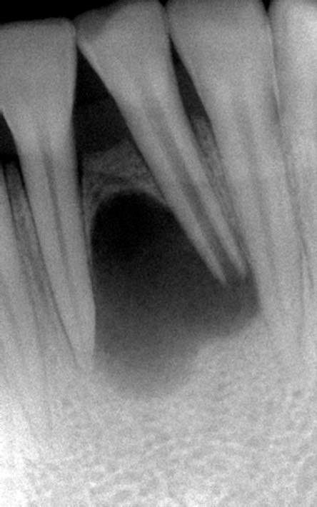Diagnostic Findings: Tooth Perc Palp Prob Mob Cold #22 WNL WNL WNL WNL WNL #23 WNL WNL WNL WNL WNL #24 WNL WNL WNL WNL NR #25 WNL WNL WNL WNL WNL #26 WNL WNL WNL WNL WNL #27 WNL WNL WNL WNL WNL WNL =