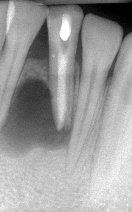 Assessment #24 Pulpal necrosis with associated coronal discoloration and asymptomatic periradicular periodontitis Plan Discussed the following options with the patient: -No treatment, resulting in
