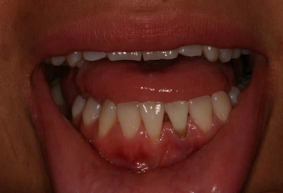 9/16/2010 Patient reported for two week whitening recall. Slight lightening of tooth noted by patient, but still discolored, particularly in root. No discomfort since last visit.