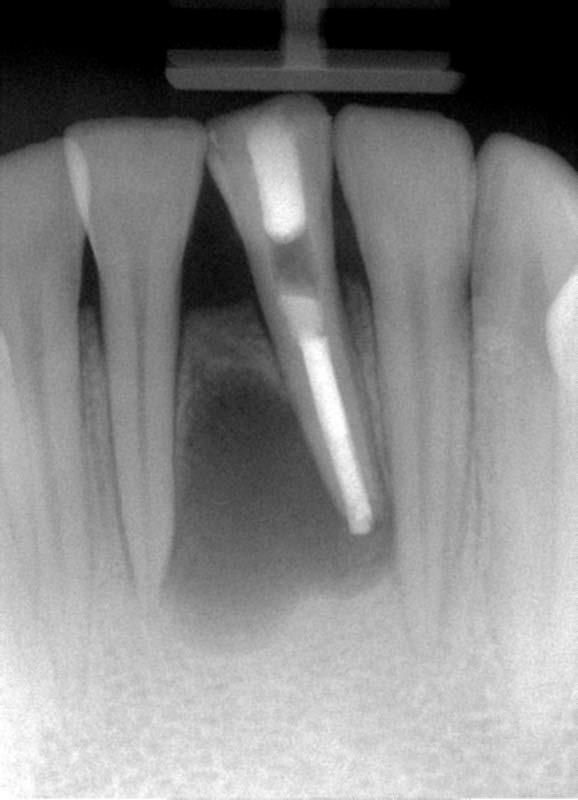 She was advised to stop this to allow the tooth to heal. No visual changes in tooth shade observed since last appt.