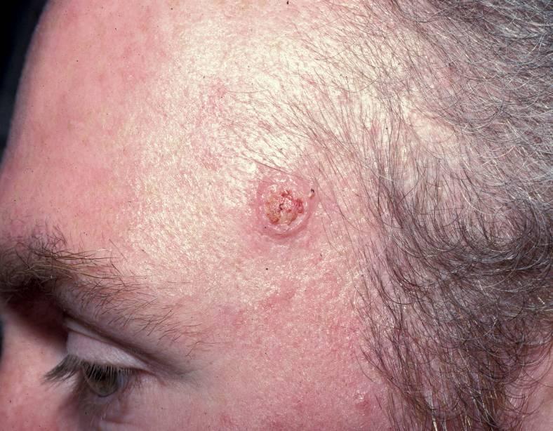 Squamous Cell Carcinoma Several cohort studies have now documented that there is a higher incidence of SCC and BCC in HIV Risk factors:
