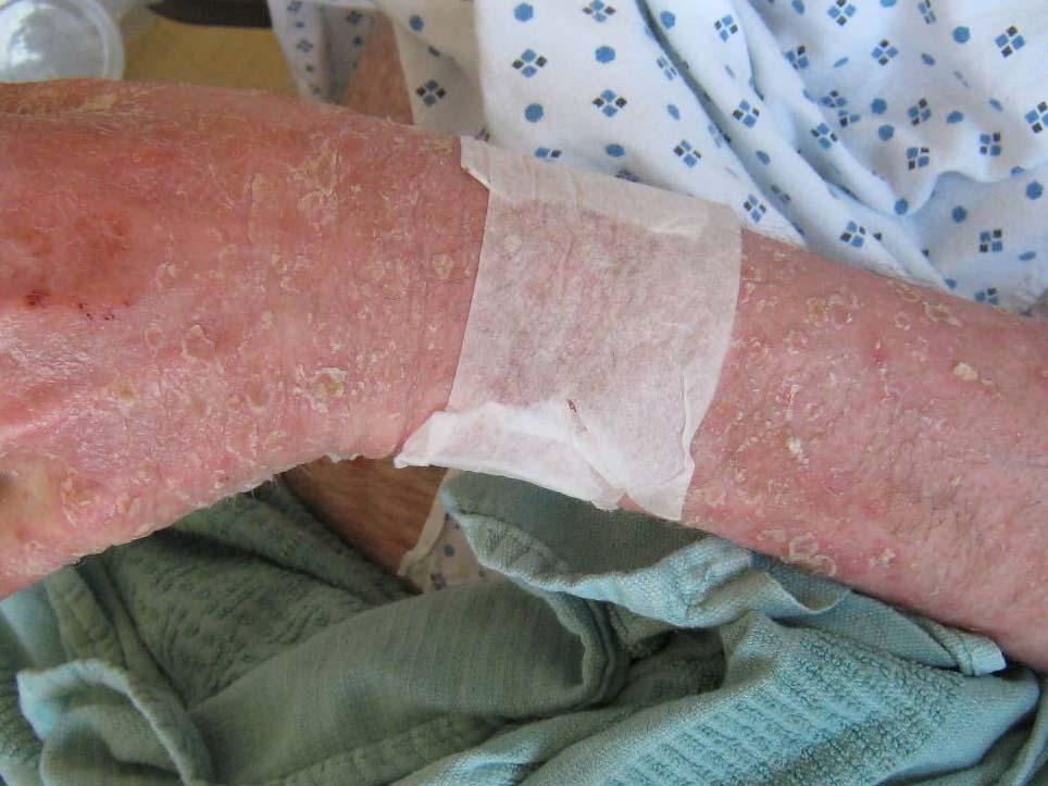 New Directions Is psoriasis exacerbation associated with drug resistance?