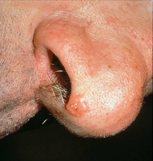 Basal Cell Carcinoma Non-metastatic but can destroy large areas of skin On face, surgical excision recommended Curretage