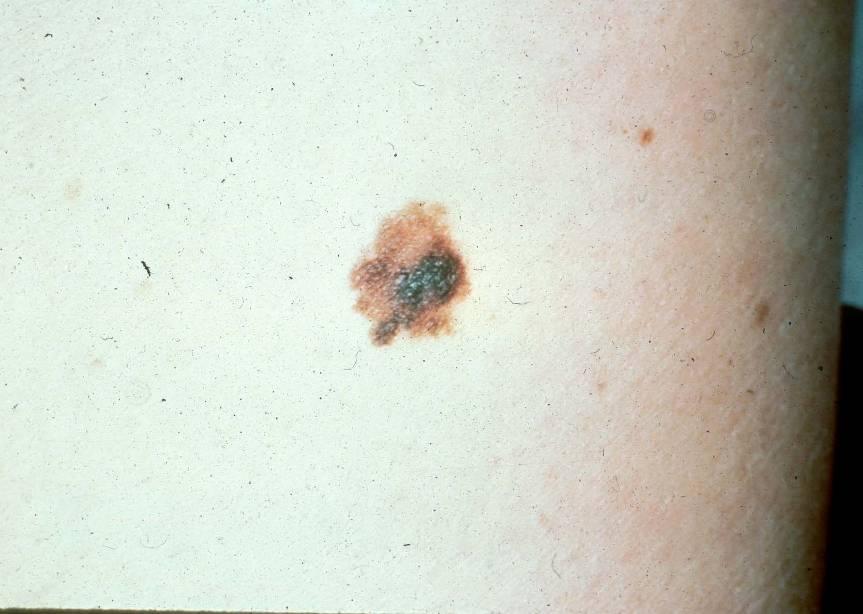 Melanoma Melanoma in HIV may be more aggressive when compared by tumor thickness Sentinel node biopsy recommended at shallower