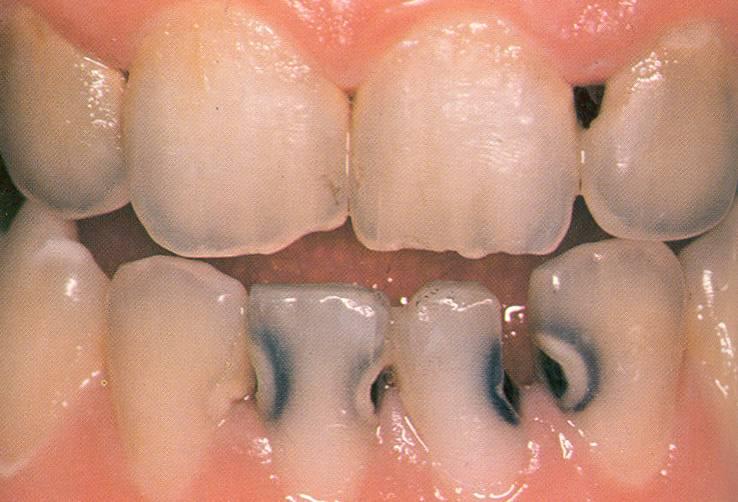 influences Geographic influences Rampant Caries
