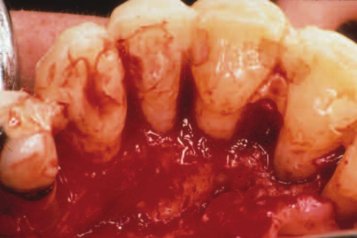 veneers were performing t cliniclly cceptle level (Figure 9). Over the next 3.