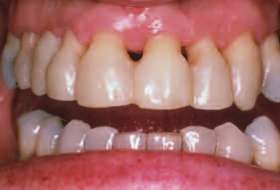 6 with susequent frcture of the porcelin veneer on tooth No. 7. At the 6.