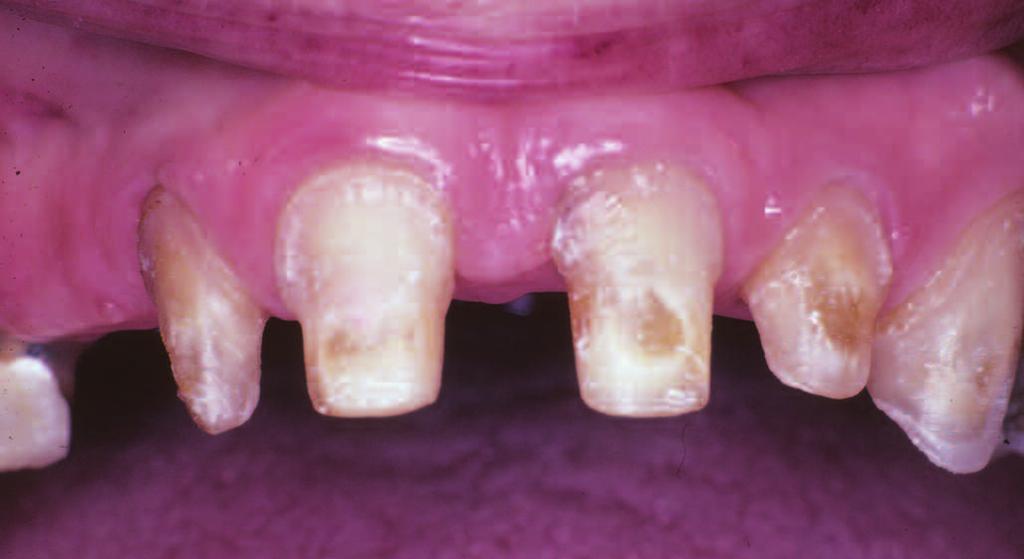 dignosis of gingivitis (Figures 13 nd 13).
