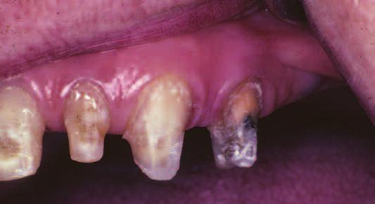 fier reinforced dhesive composite resin fixed-prtil denture (Riond THM).