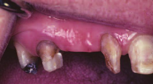 of recll (Figure 14). The ptient hs mintined the remining mxillry teeth.