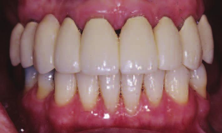 The presumption ws tht splinting to control tooth moility ws required to control gingivl inflmmtion, periodontitis, nd pocket