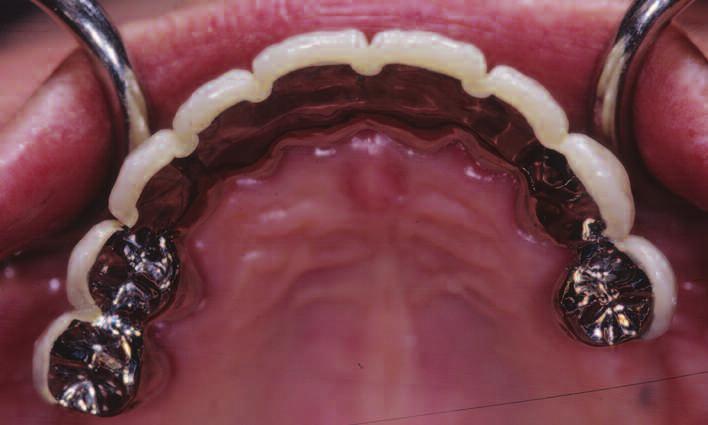 This rticle presents 12-yer recll cse for periodontlly compromised mxillry dentition in which the teeth were occluslly djusted