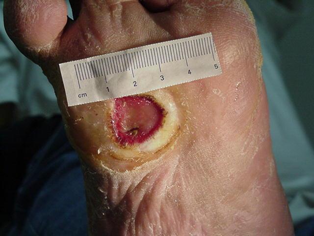 2 cm foot ulcer is smaller