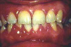 within infected periodontal