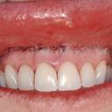 433 Lip Repositioning for Reduction of Excessive Gingival Display: A Clinical Report Ari Rosenblatt, DMD, DDS* Ziv Simon, DMD, MSc* Excessive gingival display can be managed by a variety of treatment