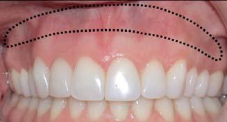 Therefore, lip repositioning is recommended as an alternative treatment for excessive gingival display.