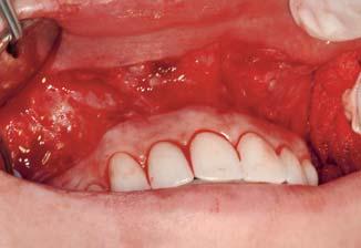 The lip mucosa is then sutured to the mucogingival line, resulting in a narrower vestibule and restricted muscle pull, thereby reducing gingival display during smiling.