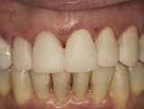 Fig 19. Fig 20. Conclusion Provisional veneer fabrication has often challenged dentists, especially when an adjacent single anterior crown is involved.