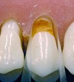 Objective To visually observe the results of using a matrix that confines and anatomically shapes a direct composite restoration, resulting in highly polished surfaces, excellent gingival margins,