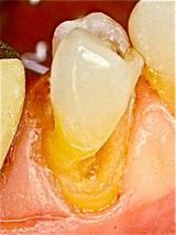 258 A Clinical Case: Caring for a healthy geriatric patient, the decision was made to restore this lower pre-molar with a direct composite restoration rather than sacrifice healthy tooth structure