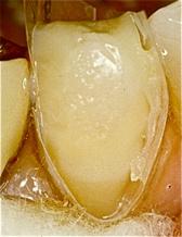 The entire surface areas of the tooth structures Inside of this fixed mold were scrubbed with EDTA or 5.