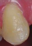 Procedures that I use direct composite resins for include: Class I restorations Class II restorations Class III restorations Class IV restorations Class V restorations Tooth shaping Tooth alignment
