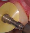 Proper technique involves many components including the following: proper preparation technique for each procedure; method of material placement this involves complete understanding of tooth