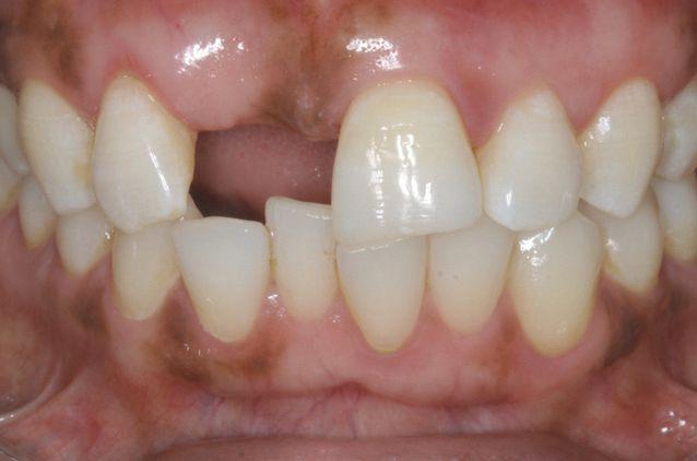 construction of the missing right central incisor. b. Cover exposed Ribbond and properly contour the lingual surfaces of both incisors with the use of nano-fill composite. c. Create a freehand matched right central incisor with proper bonding techniques.