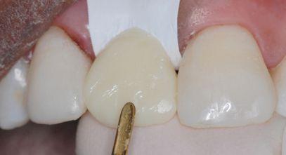 creation of a smooth gingival